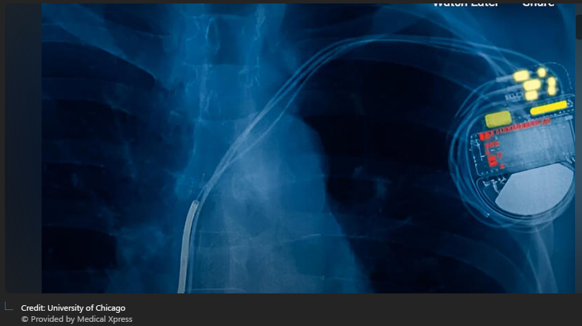 A x-ray of a person's chest

Description automatically generated